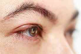 Khô mắt có dẫn đến viêm kết mạc?