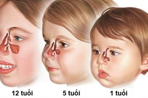 Nguyên nhân gây viêm xoang ở trẻ