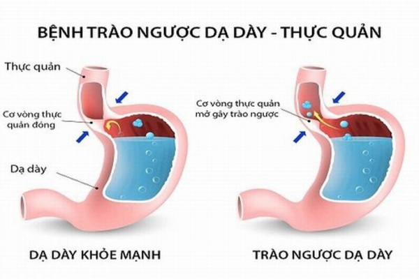 Vì sao trào ngược dạ dày thực quản lại gây ho?