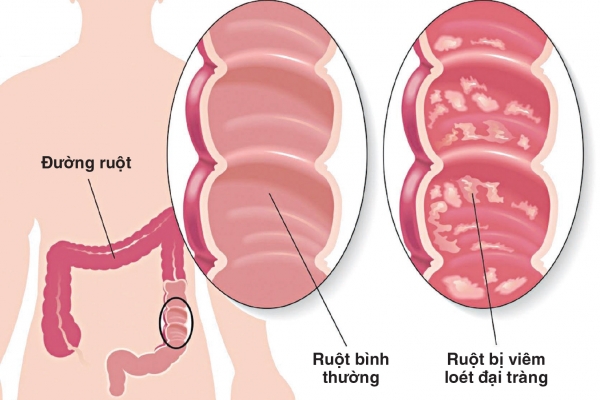 Điều trị viêm loét đại trực tràng chảy máu
