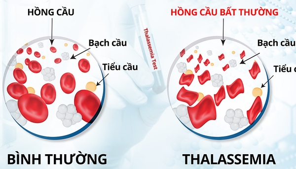 Mắc tan máu bẩm sinh có nguy cơ gì?